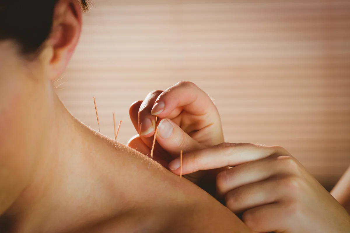 3 Acupuncture Myths That Still Exist Today