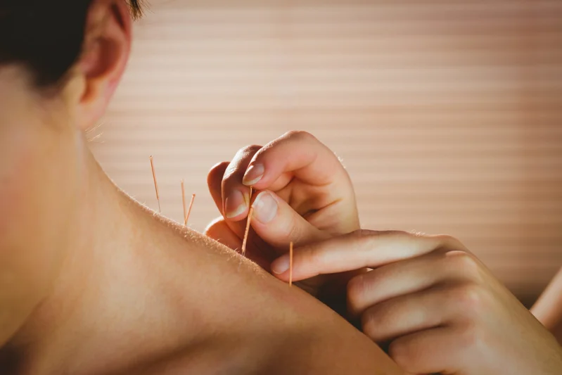 3 Acupuncture Myths That Still Exist Today