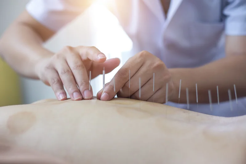 5 Questions to Ask Your Medical Professional About Acupuncture
