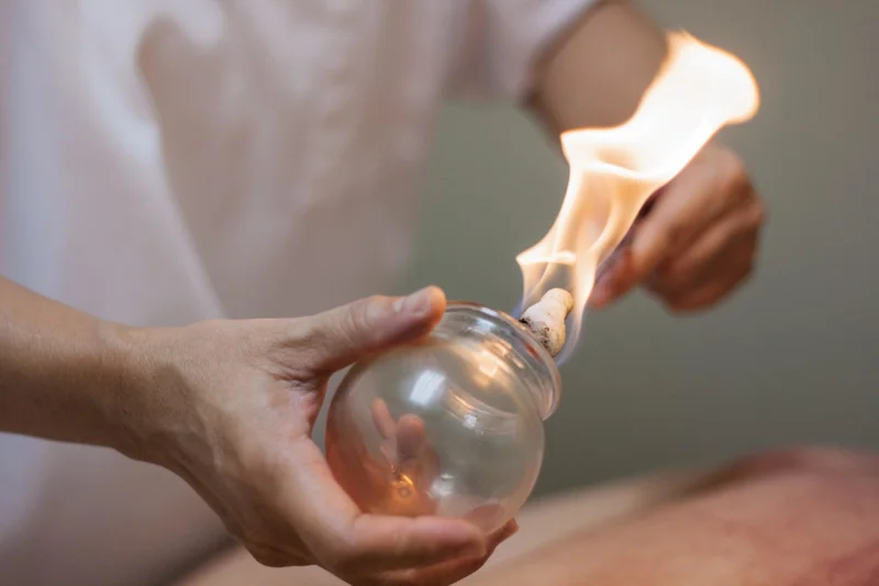 Cupping Therapy and 3 Surprising Benefits